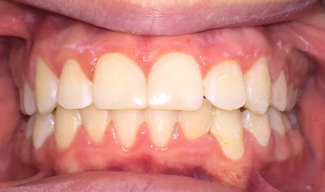 Vista frontale degli stessi denti dopo il trattamento ortodontico: arcate allineate
